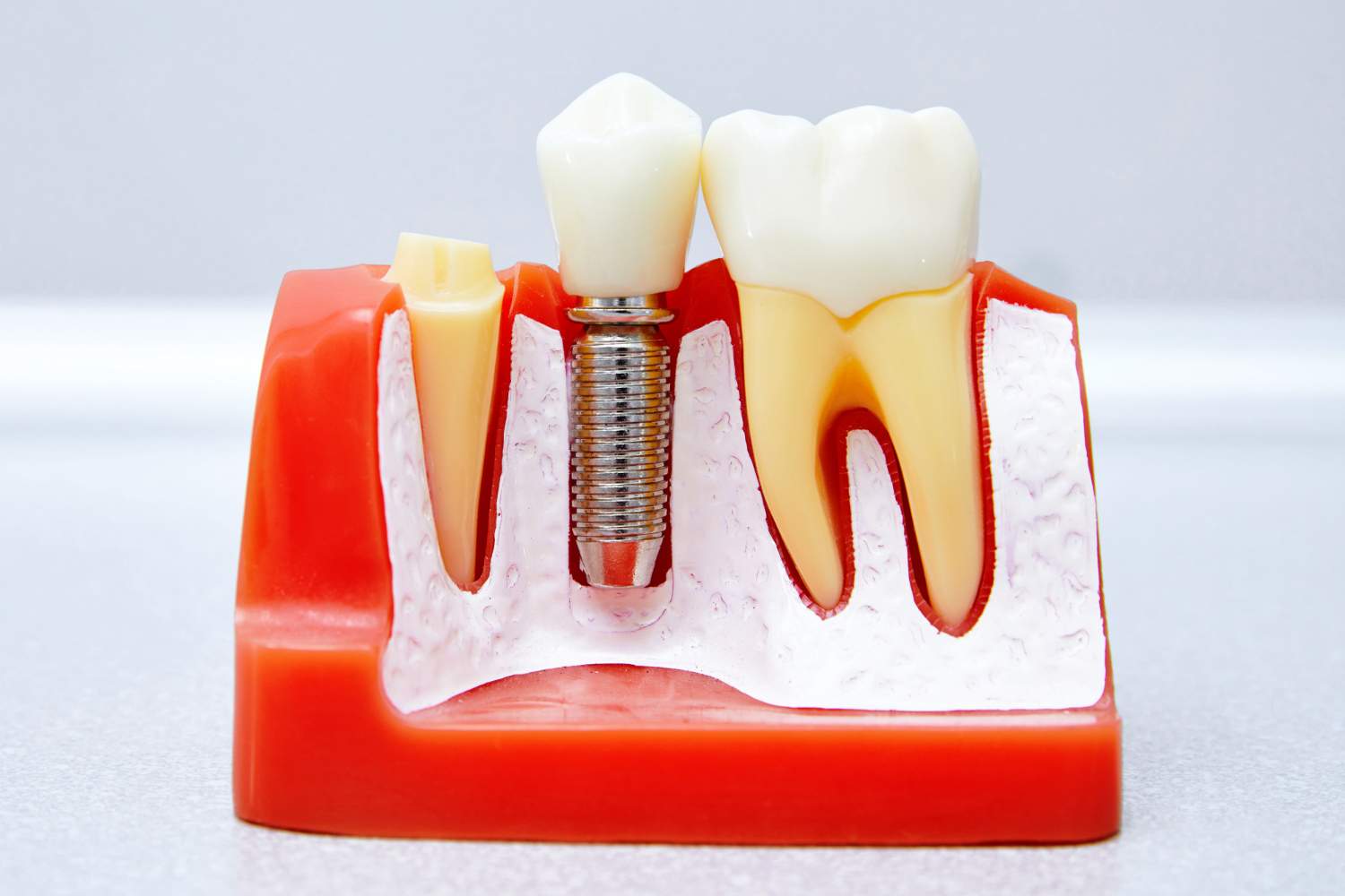 section-of-dental-implant