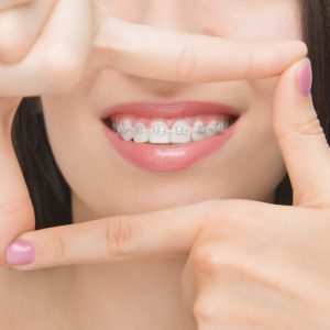 dental-braces-in-happy-woman-s-mouths-through-the-frame-brackets-on-the-teeth-after-whitening-self-ligating-brackets-with-metal-ties-and-gray-elastics-or-rubber-bands-for-perfect-smile