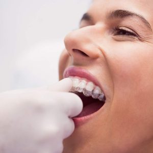 dentist-assisting-female-patient-to-wear-braces