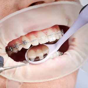 dentist-attaching-metal-braces-to-patient-teeth